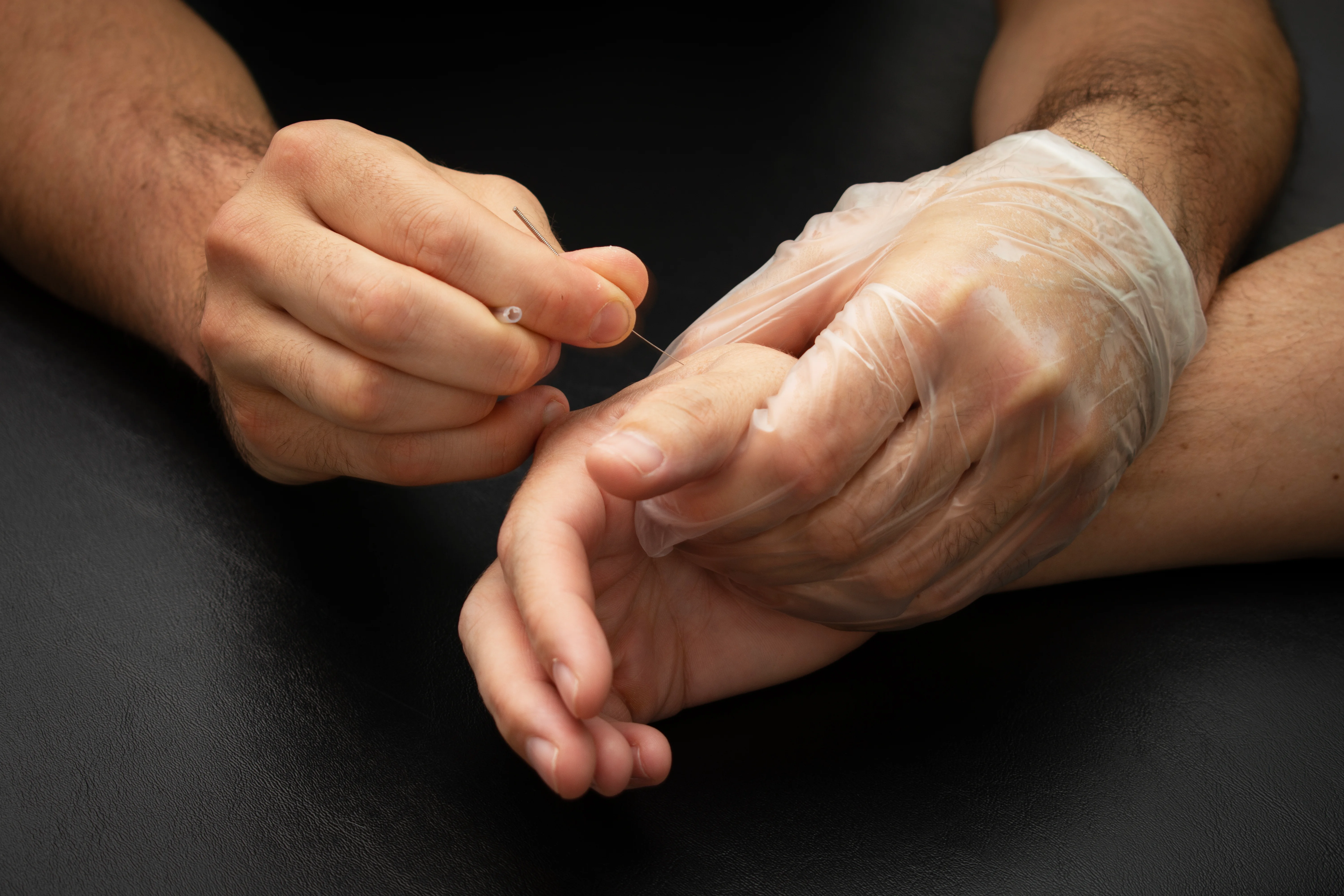 A gloved hand steadying a patient's hand while a fine needle is placed into the muscle below the thumb.