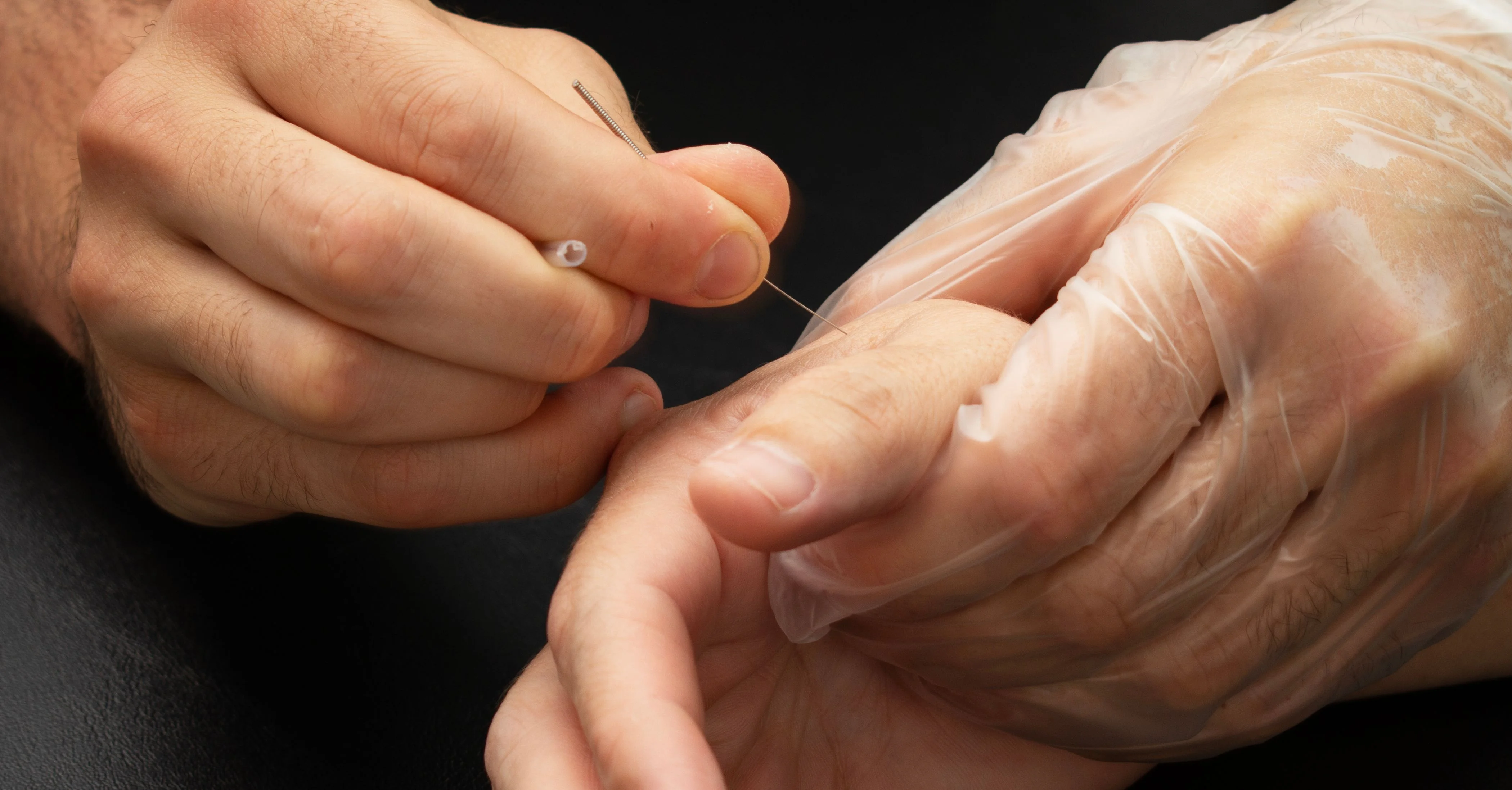 A gloved hand steadying a patient's hand while a fine needle is placed below the thumb.