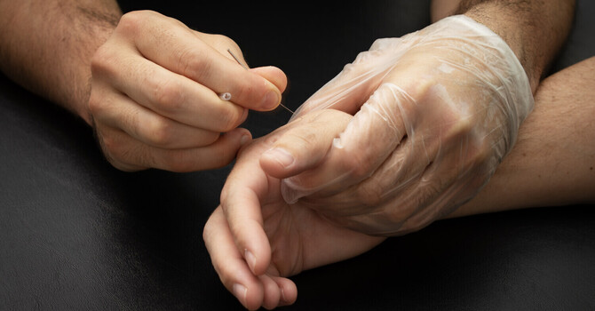 Dry Needling